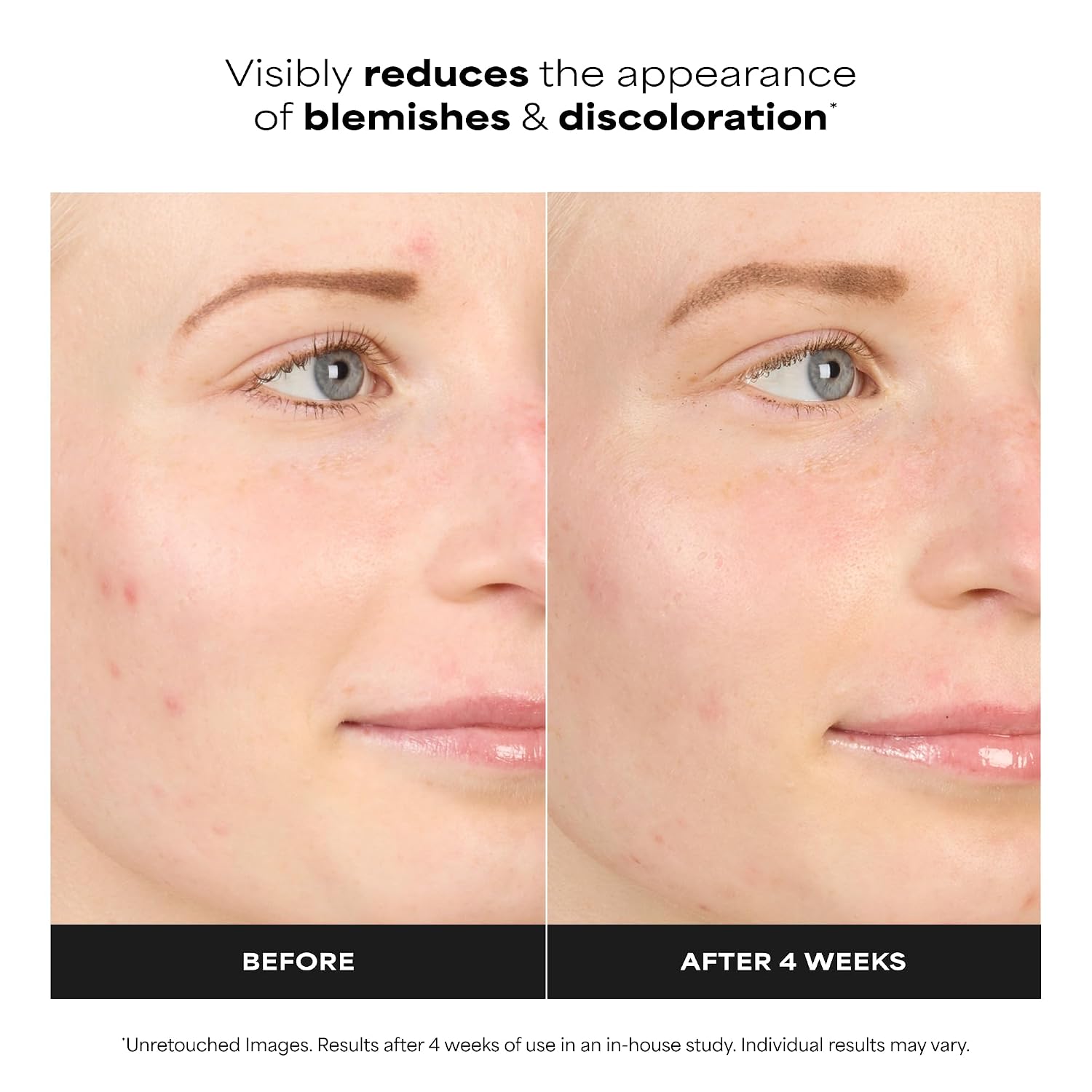 Paula's Choice BOOST 10% Azelaic Acid Booster Cream Gel, 1 Fl Oz | Oil-Free Serum Fades Discoloration & Post-Blemish Marks with Licorice Extract & Salicylic Acid, Fragrance-Free
