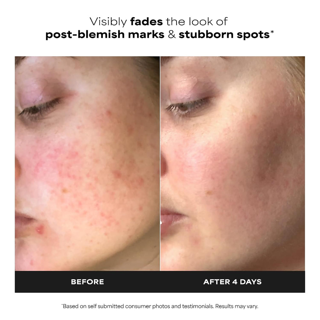 Paula's Choice BOOST 10% Azelaic Acid Booster Cream Gel, 1 Fl Oz | Oil-Free Serum Fades Discoloration & Post-Blemish Marks with Licorice Extract & Salicylic Acid, Fragrance-Free