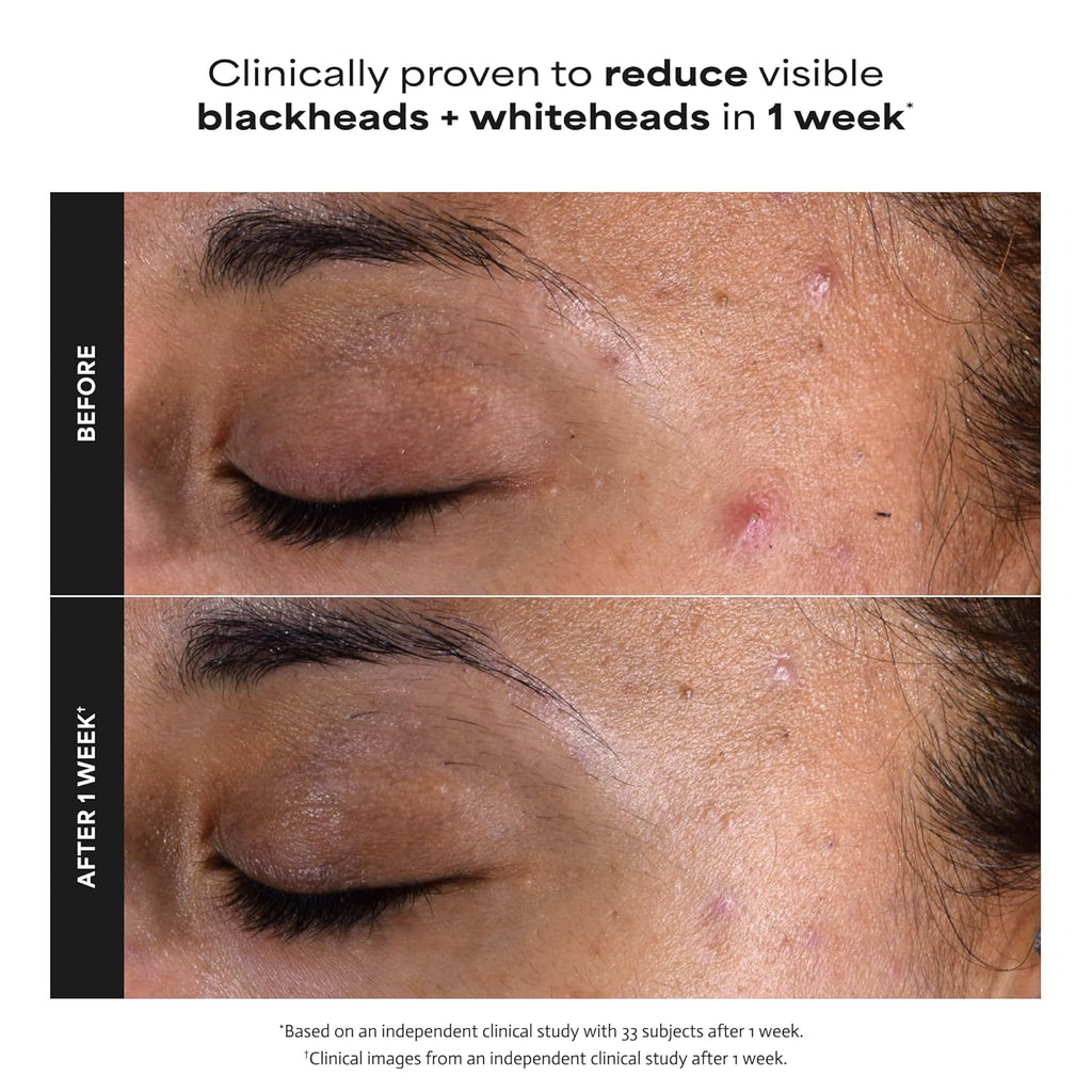 Paula's Choice SKIN PERFECTING 2% BHA Liquid Exfoliant | Gentle Salicylic Acid Facial Exfoliator for Blackheads, Enlarged Pores, Wrinkles & Fine Lines
